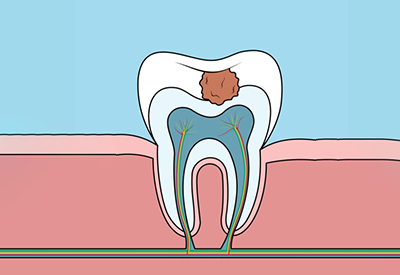 Animeret billede af hul i tand, som vi kan lave for dig som patient hos vores tandlæge i Odense